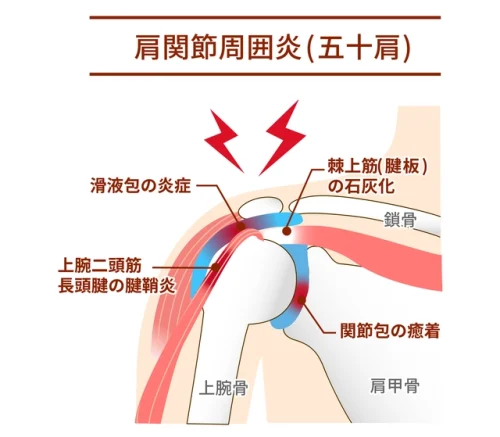 肩関節周囲炎（五十肩・四十肩）